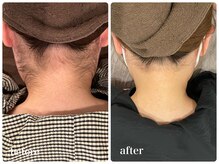 エリクサー 加須店(Elixir)/女性隠れ人気メニューうなじ脱毛