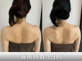 フラット(flat)の写真/大切な日の準備に駆け込みOK◎背中・首肩・フェイスラインを整えるブライダル集中ケア