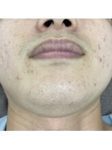 ナノハナ/鹿沼市の全身脱毛美容室ナノハナ