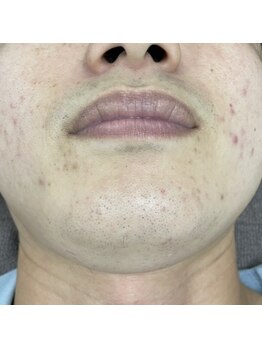 ナノハナ/鹿沼市の全身脱毛美容室ナノハナ