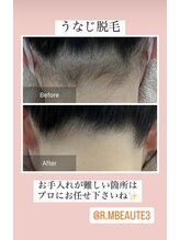アールエム ボーテ(RM beaute')/うなじ脱毛