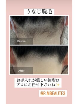 アールエム ボーテ(RM beaute')/うなじ脱毛