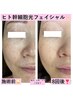 【シミ、しわ、毛穴、くすみ、たるみ最高峰ヒト幹細胞ケア】光フェイシャル★