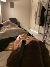 ラフテル鍼灸整骨院/結婚式前には美容鍼で整えよう♪