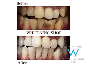 ホワイトニングショップ 甲賀店/Before&After『ホワイトニング』