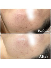 ミレーヴ(MiReve)/ニキビ・赤み