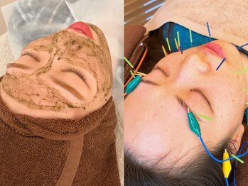 ノフ 恵比寿(noff)の写真/美容鍼と選べる本格ケアメニューが人気★ニキビのお悩みにはハーブピーリングとの組み合わせがおすすめ◎