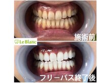 ルブラン 奈良店(Le Blanc)/がっつり白く！