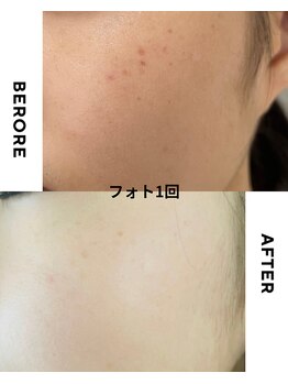 アレイズ(ARAYS)/症例