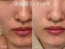 ハティア(hattia)/肌活♪月2回お肌のお掃除で美肌