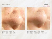 毛穴の開きや凹凸にも◎ナチュラルピーリング×温熱石膏パック