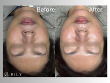 リリー(RILY)/レッドショットビフォーアフター