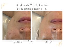 プリトリート(Pritreat)/シミケアし放題＆ヒト幹細胞