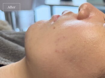 キュレイテッドスキン(CURATED SKIN)/ピーリング/毛穴ケア/肌質改善