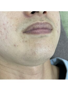 ナノハナ/鹿沼市の全身脱毛美容室ナノハナ