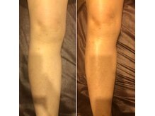 左側・施術前→右側・施術後　浮腫が取れると、スッキリ軽い脚！