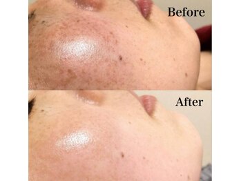 イリゼ(iriser)/ハーブピーリングBeforeAfter