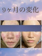 エクシア(excia)/ニキビケア