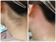 ヒスイ バイ アメイジング(Hisui by AMAZING)/うなじ/脱毛/シェービング/WAX