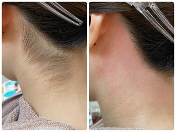 ヒスイ バイ アメイジング(Hisui by AMAZING)/うなじ/脱毛/シェービング/WAX