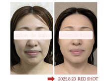 サロン ド 花歩 松山本店/気にしていた法令線が消えた！