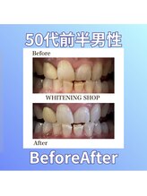 ホワイトニングショップ 西原店/50代前半男性☆BeforeAfter