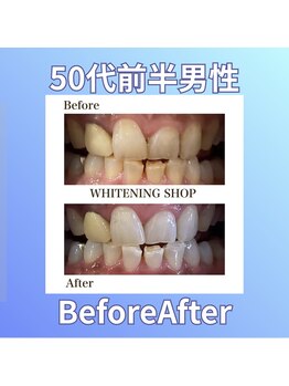 ホワイトニングショップ 西原店/50代前半男性☆BeforeAfter