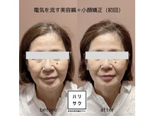 ハリサク/初回施術