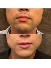 フェリーバ(FELIVA)/お髭が濃いなとお悩みの方