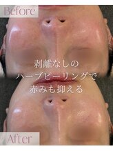 モア 星ヶ丘店(MORE)/ハーブピーリング