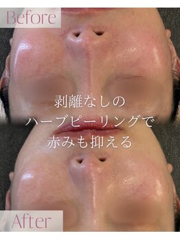 モア 星ヶ丘店(MORE)/ハーブピーリング