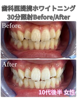 プラチナムビューティ 四条烏丸店(PLATINUM Beauty)/ホワイトニング!Before./After!