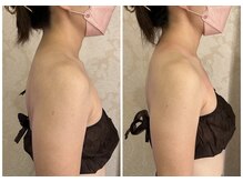 アンベリールプラス(embellir+)/40代慢性的な肩こり