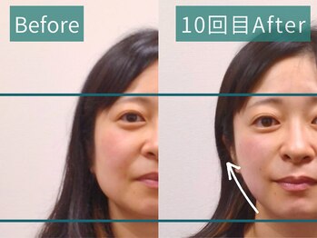 カンワ美容鍼灸院(KANWA美容鍼灸院)/30代女性美容鍼１０回目
