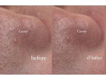 クレヴィー(Creviy)/潤艶wax脱毛(産毛脱毛)1回施術