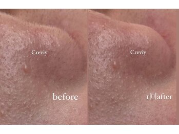 クレヴィー(Creviy)/潤艶wax脱毛(産毛脱毛)1回施術