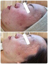 クレイルサロン(Claire salon)/初回施術前後