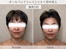 フラリ 西葛西(Hulali)/【30代】顔＋背中スッキリケア