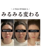 キュープ 群馬吉岡店(Qpu)/美肌もお任せください♪小顔