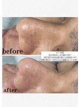 ジョルフ サロン オリジナル(JOLF salon original)/毛穴洗浄