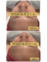 リラクゼーションサロンブラン(Bulan)/WIQO水光ピール