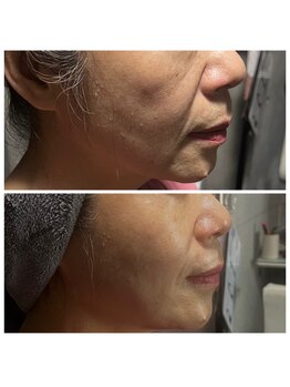 ヴィナーレ(VINARE)/ドクターリセラ/肌改善