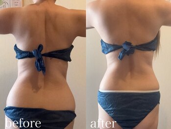 グレイティア(gratia)/背中スッキリ♪