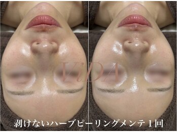 ヴィーダ 渋谷松濤(ViDA)/くすみ/乾燥/ゴワつき改善