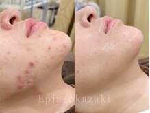 エピア 岡崎店(Epia)の雰囲気（長年悩んでいた肌荒れもEpiaのニキビケアで肌改善に導きます！）
