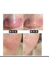 アオヤマ サロン ワイゼット(AOYAMA SALON YZ)/赤み・肌荒れケア