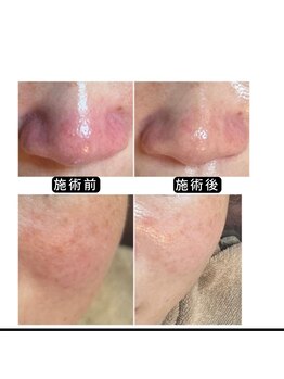 アオヤマ サロン ワイゼット(AOYAMA SALON YZ)/赤み・肌荒れケア