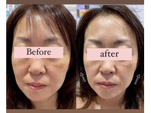 アリウム(Allium)/痩身機械で小顔へ