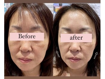 アリウム(Allium)/痩身機械で小顔へ