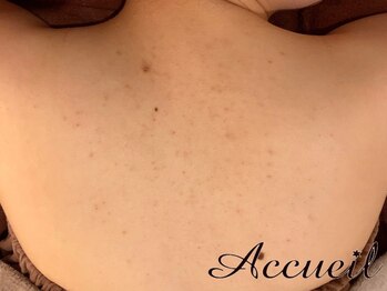 アクール(Accueil)/毛穴ケア/肌質改善/ニキビケア